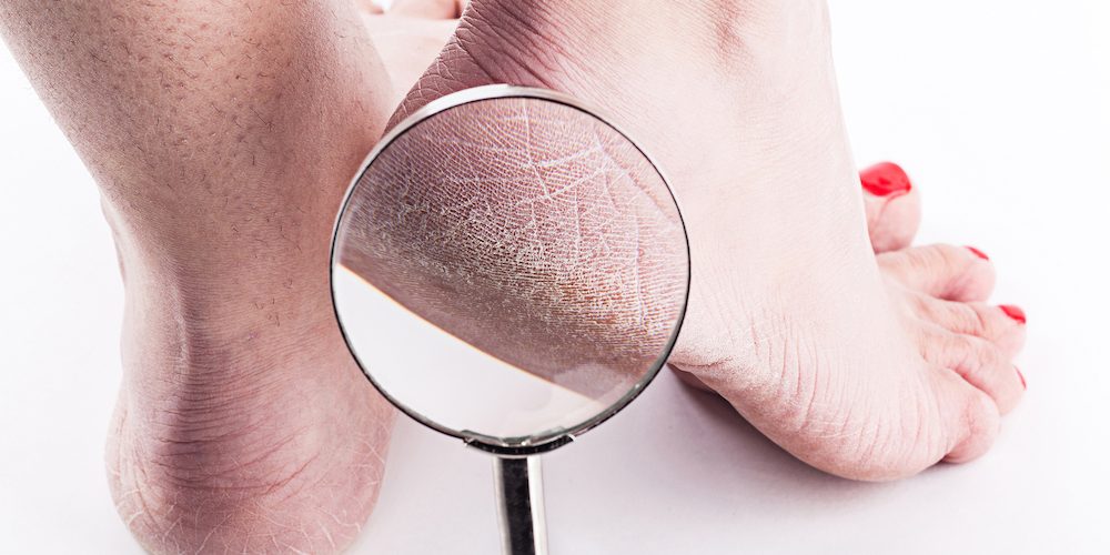 What Causes Cracked Heels?