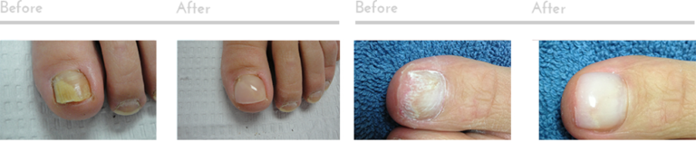 keryflex nail restoration